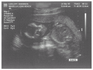 Baby Ludloff - Ultrasound 18 weeks