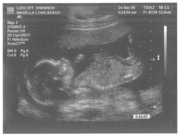 Baby Ludloff - 18 weeks